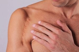 scar removal
